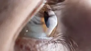 עדשות מגע לקרטוקונוס